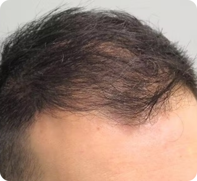 Hair thinning at the front hairline before treatment