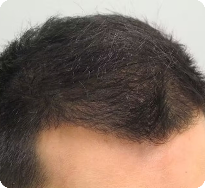 Improved hair density at the front hairline after four months