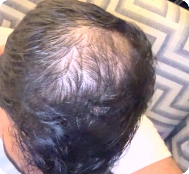 Hair thinning at the crown area before treatment