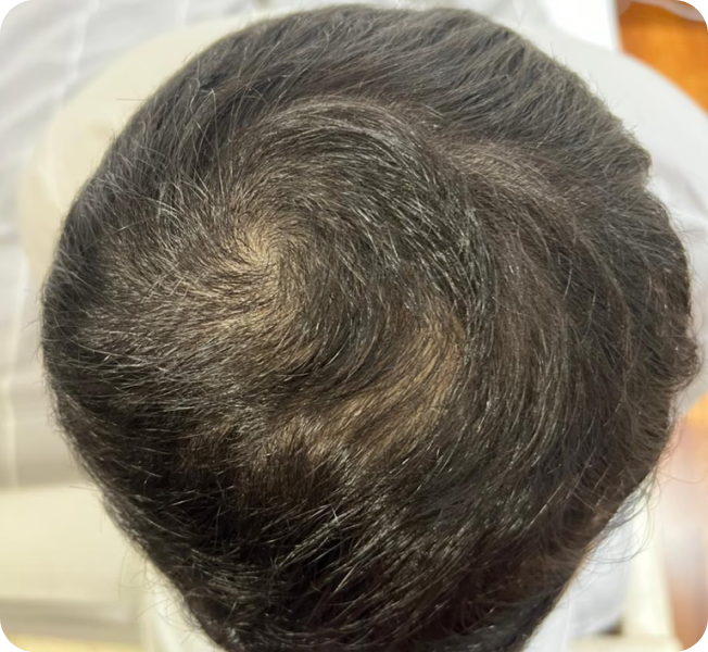 Improved hair coverage at the crown after six months