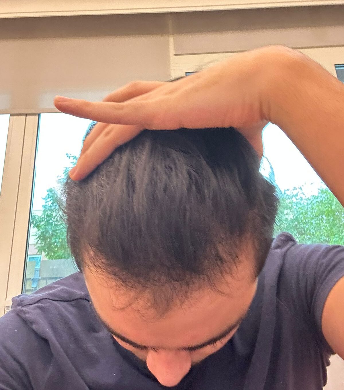 Increased hair density at the front of the scalp after six months