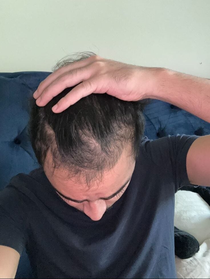 Visible hair thinning at the front of the scalp before treatment